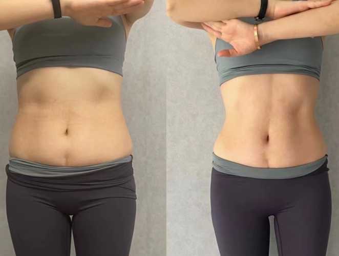 产后肚子大怎么办-第1张图片