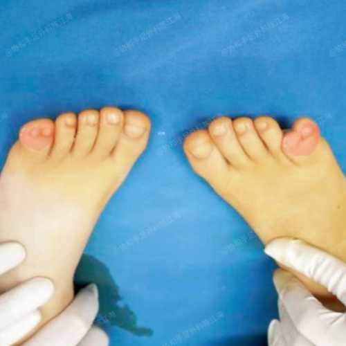 新生儿剪刀脚图片哪里有-第1张图片