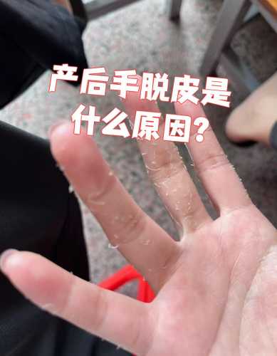 产后过敏性皮炎怎么办-第1张图片