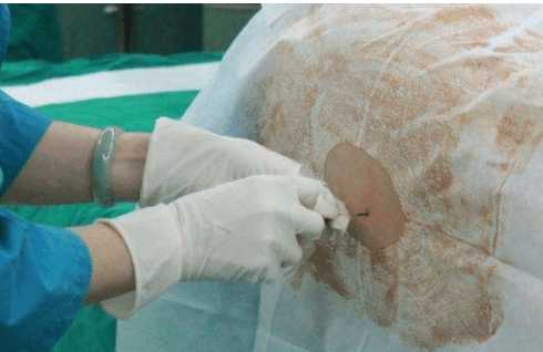 剖腹产有没有打麻药-第1张图片