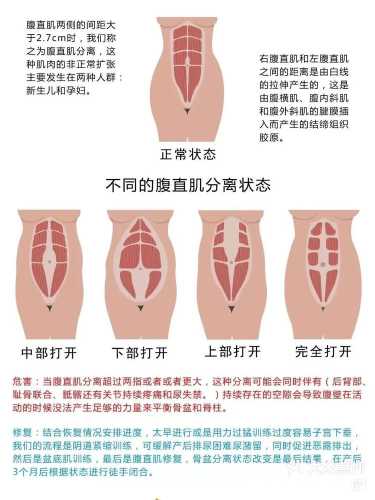 产后腹直肌如何有效恢复训练-第1张图片