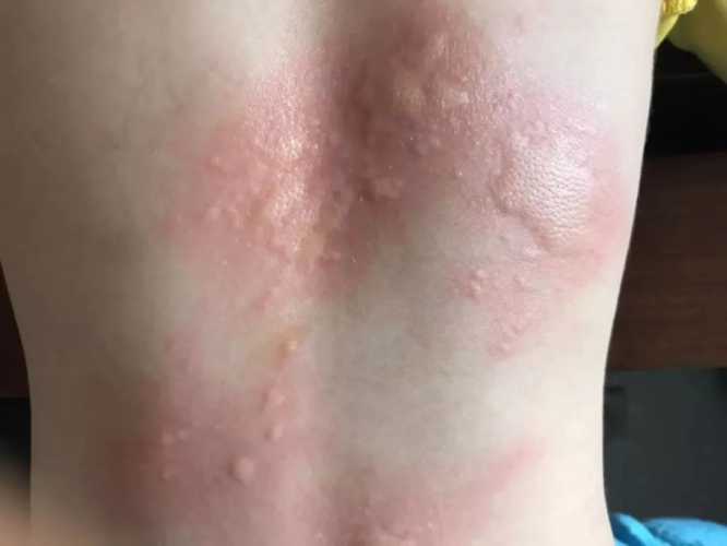 婴儿荨麻疹有啥症状表现-第1张图片