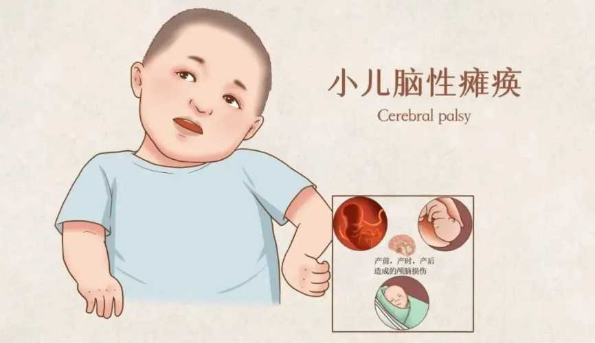 新生儿脑损伤早期有啥表现-第1张图片