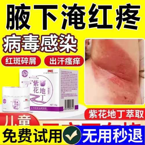 婴儿真菌感染怎么办-第1张图片