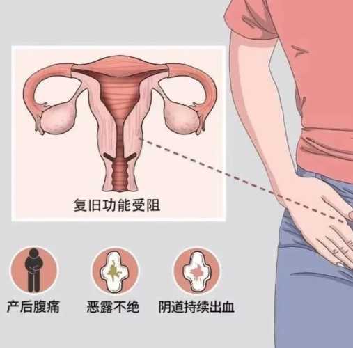 产后恶露干净后为何又出血-第1张图片