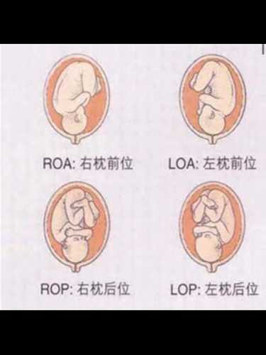胎位rop能顺产吗-第1张图片