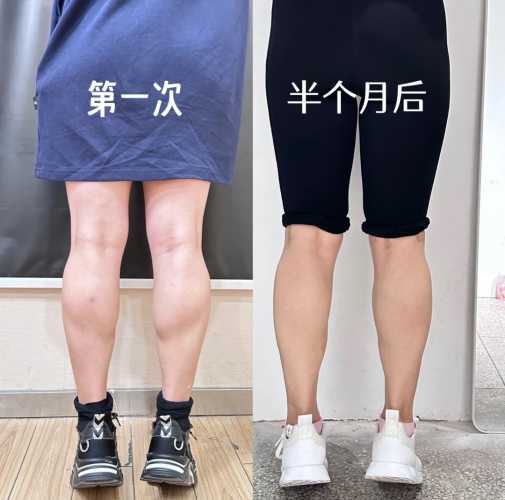 怀孕能瘦腿吗是真的吗-第1张图片