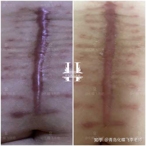 剖腹产增生前期啥情况-第1张图片